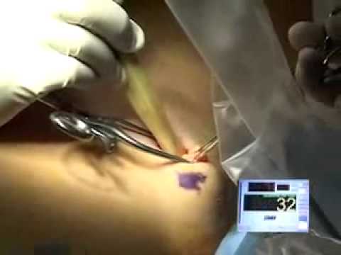 Sentinel lymph node mapping — intraoperative gamma-probe technique (melanoma)