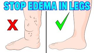 How to naturally reverse edema swelling in your legs