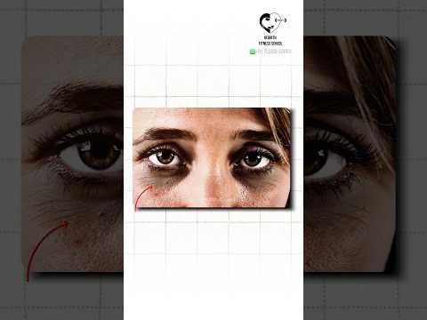 Dark circles under the eyes | Sunken eyes- Dr. Isacc Abbas