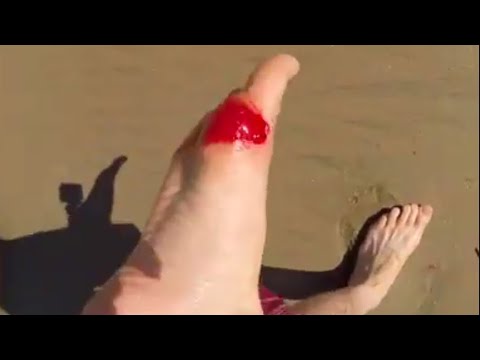 Stung by a Stingray LIVE on film!!