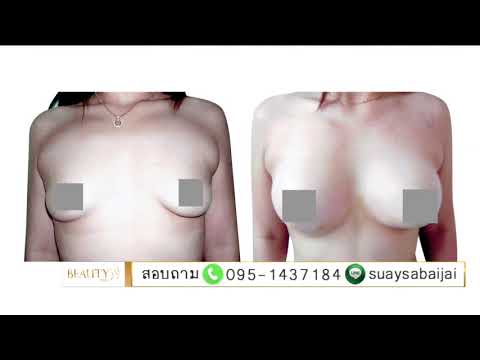 หน้าอกพลาสติกในอีร์คุตส เหตุผลที่ฉันได้หน้าอกเล็กผมอายุ 13 ปี