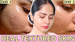 TEXTURED SKIN: How I Got Rid Of Rough Bumpy Grainy Texture On face ✅