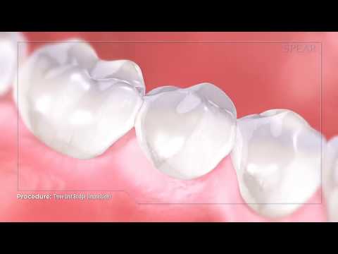 Conventional Dental Bridge