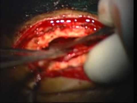 Overeyeball Minimaly Invasive Access To The Anterior Cranial Fossa For Base Correction