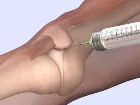 Come fare una risonanza magnetica della colonna cervicale Congedo per malattia del menisco del ginocchio post-operatorio