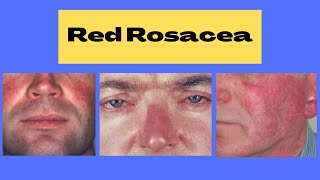 Rosacia | Rosacea Red Nose | Red Face Rosacea