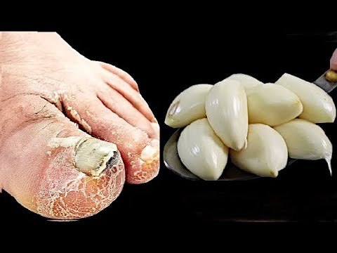 Cure toenail fungus. Best Recipe. Prepare in 1 minute! less than $1. You have to do it!