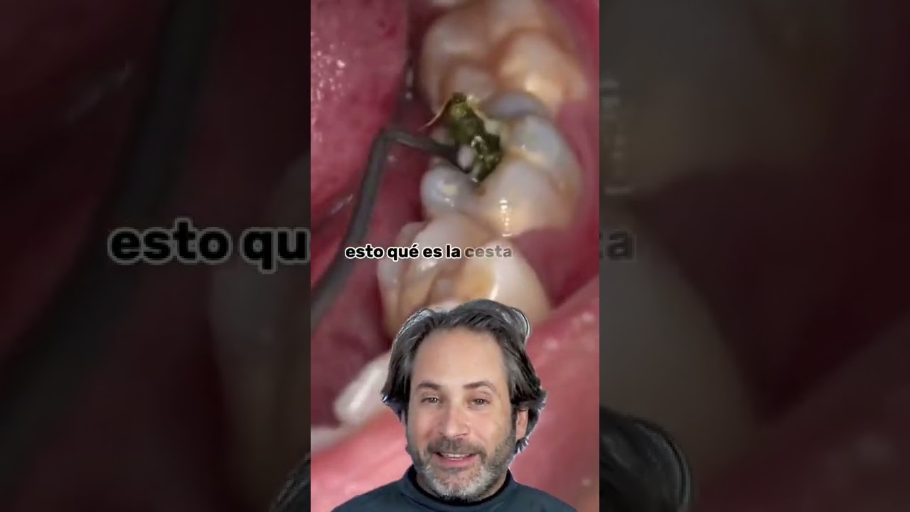 Watch ¿Tienes una caries profunda en una muela Mira todo lo que puede esconder (¡SOLUCIÓNALO YA!) Now ¿Tienes una caries profunda en una muela Mira todo lo que puede esconder (¡SOLUCIÓNALO YA!)