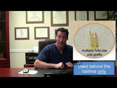 How Much Does a Hair Transplant Cost? Video