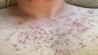 how to get rid of chest acne scars home remedies