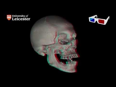 micro-CT Scan of Richard III's Skull 3D (Red - Blue 3D glasses required)