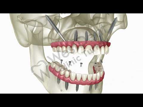 Logo of Expert Insights on Full Mouth Zygomatic Dental Implants in Izmir, Turkey