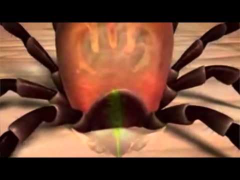 Die Wahrheit über Zecken-Angriffe