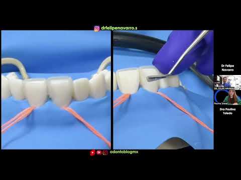 ¿Cómo cerrar un Diastema con resina?
