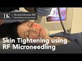 Skin Tightening of the Face using Radio-Frequency (RF) Microneedling by Dr. Hooman Khorasani