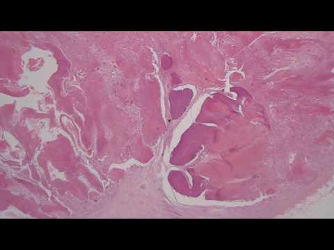 C44.6_Pilomatricoma_skin_excision
