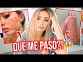 TENGO RONCHAS EN TODO MI CUERPO!!! LA PEOR EXPERIENCIA DE MI VIDA ðŸ˜| Katie Angel TENGO RONCHAS EN TODO MI CUERPO!!! LA PEOR EXPERIENCIA DE MI VIDA ðŸ˜| Katie Angel