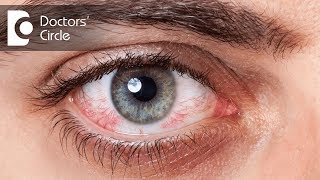 Why do I always wake up with red eyes? - Dr. Sriram Ramalingam