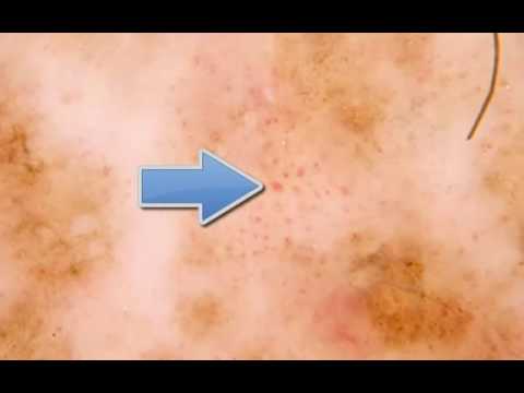 Quello che il peeling per la persona che candeggia Mi voglio una lentiggine