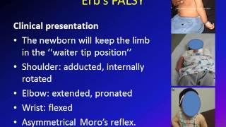 Obstetric Brachial Plexus Palsy (OBPP)/ Erb's Palsy