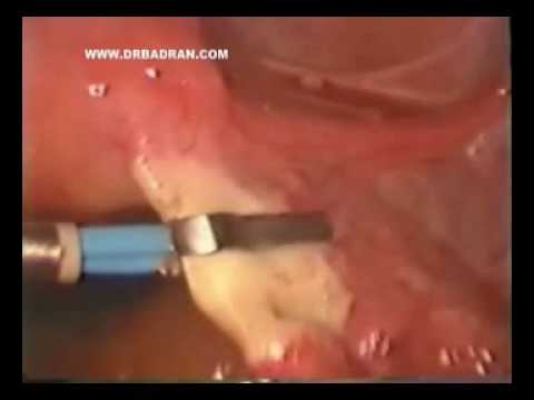 Laparoscopic Tubal Ligation