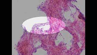 Forearm nodule voiceover