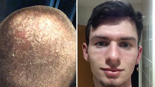 2 years no shampoo results