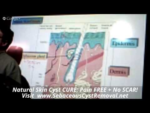 What Causes A Sebaceous Cyst | What Is A Sebaceous Cyst