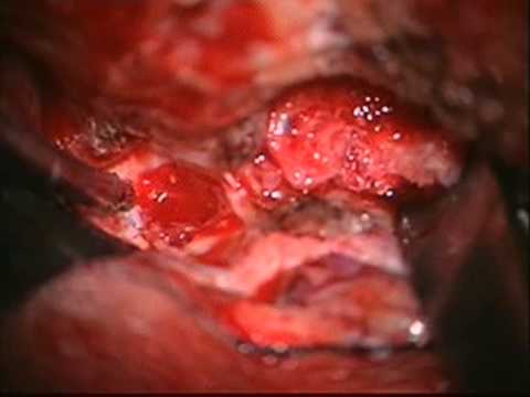 Frontotemporal extradural transcavernous approach