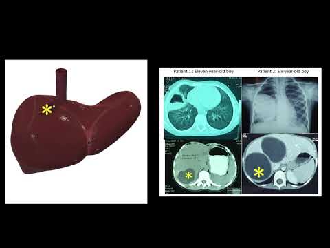 Thoracoscopic Transdiaphragmatic Excision of Hepatic Hydatid: A Novel Operative Approach