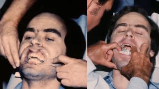 Ted Bundy bitemark Ken Katsaris Dr Souviron