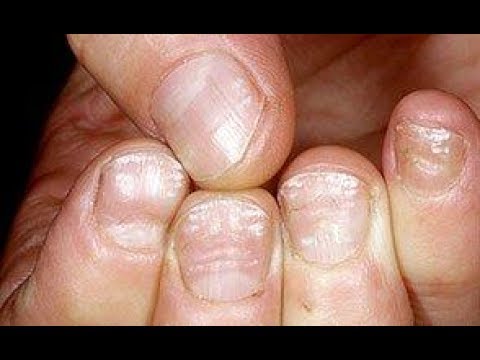 Ekzoderil in canada presyo Mga sanhi ng fungal sakit sa kuko