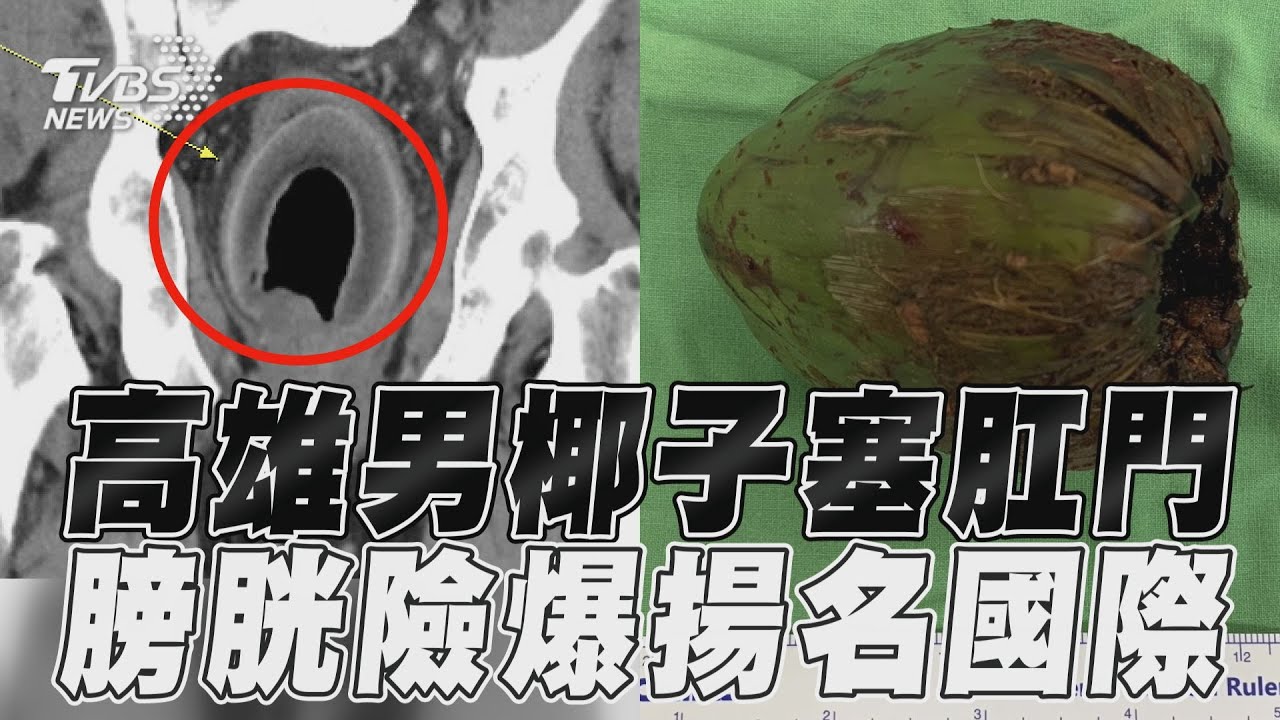 影音/求刺激?高雄男「椰子塞肛門」痛2天就診 醫:膀胱險爆炸