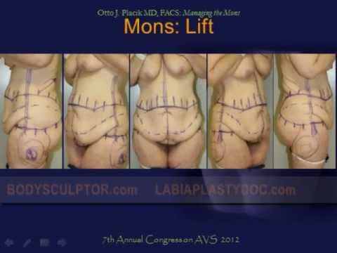 Mons Pubis Reduction  FemSculpt™ Cosmetic Gynecology