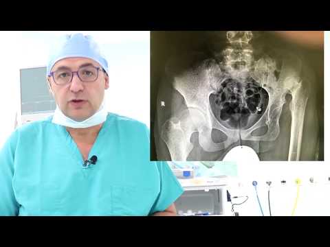 🔴 Hip Replacement Surgery - Congenital Hip Dislocation | Shaket Dabous