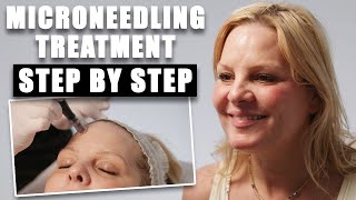 The Ultimate Microneedling Facial For Flawless Skin | Microneeedling Treatment Step-by- Step