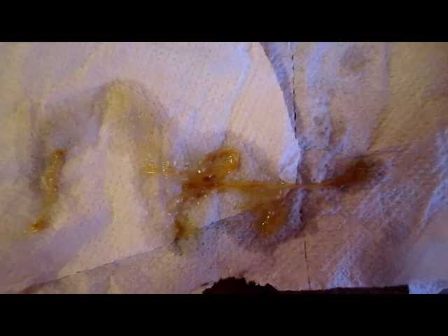 Власоглав Человеческий Симптомы Лечение Фото — Картинки фотографии