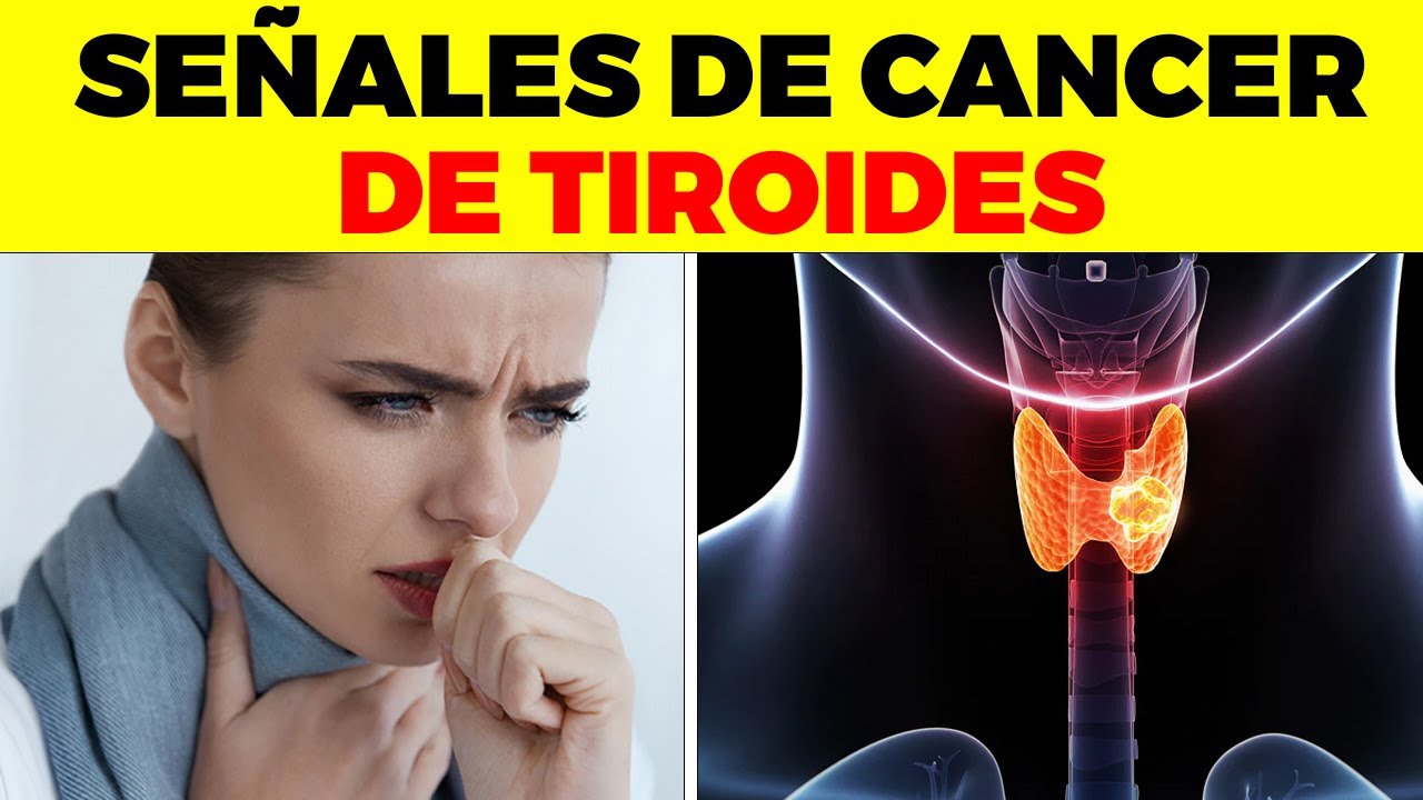 ASI EMPIEZA el Cáncer de Tiroides y nadie te lo dice, signos y síntomas de cáncer de tiroides