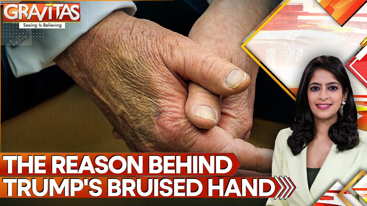 It Was Aspirin, Claims Trump, Not Old Age That Bruised Hand | GRAVITAS