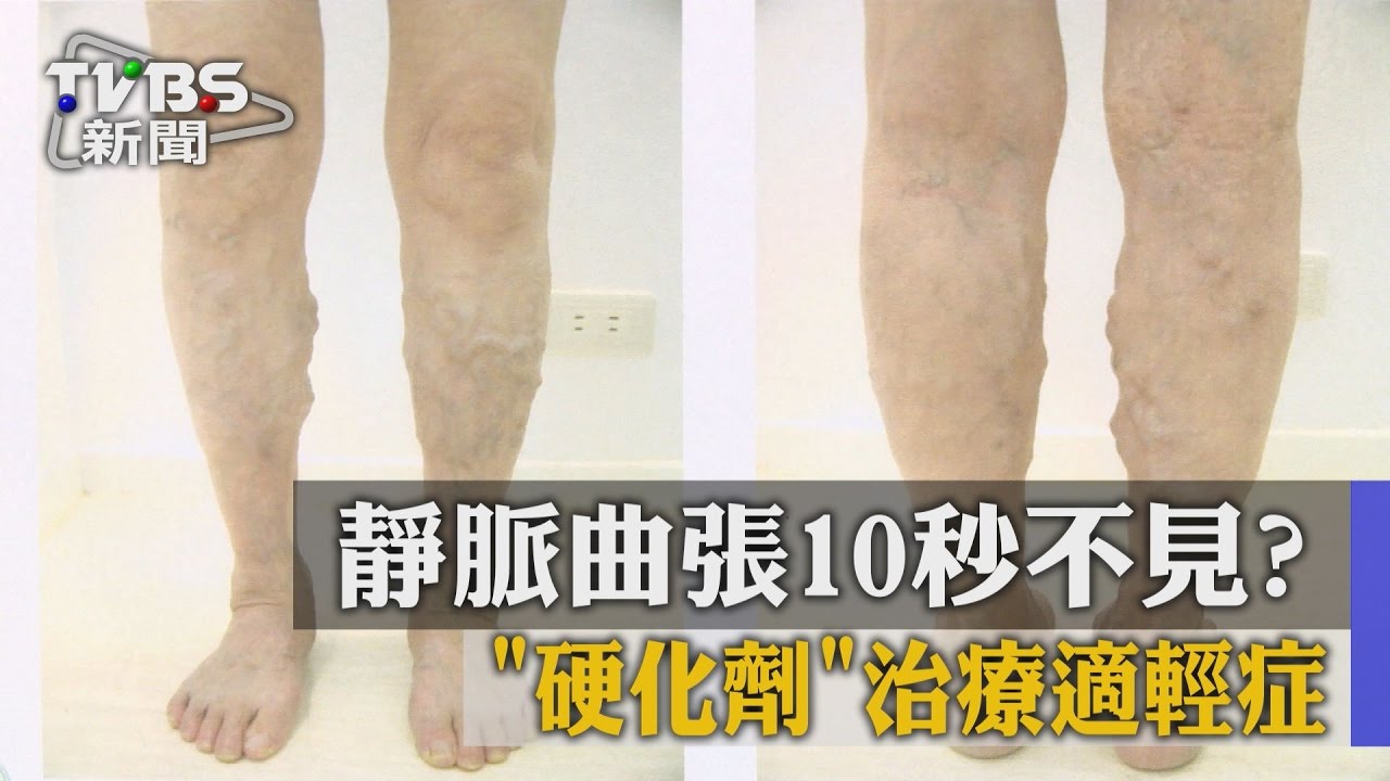 靜脈曲張10秒不見？　「硬化劑」治療適輕症