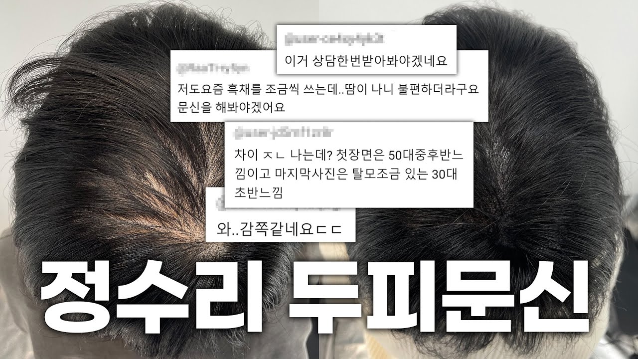 快速消除头顶脱发的方法！ "因为这种治疗而闹得沸沸扬扬的理由..."