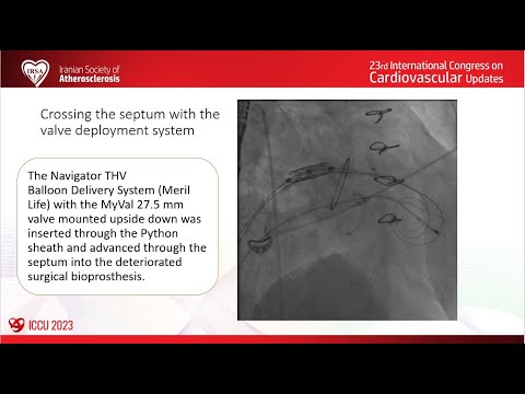 Valve‐in‐valve transcatheter mitral valve replacement (ViV TMVR): experience with MyVal system