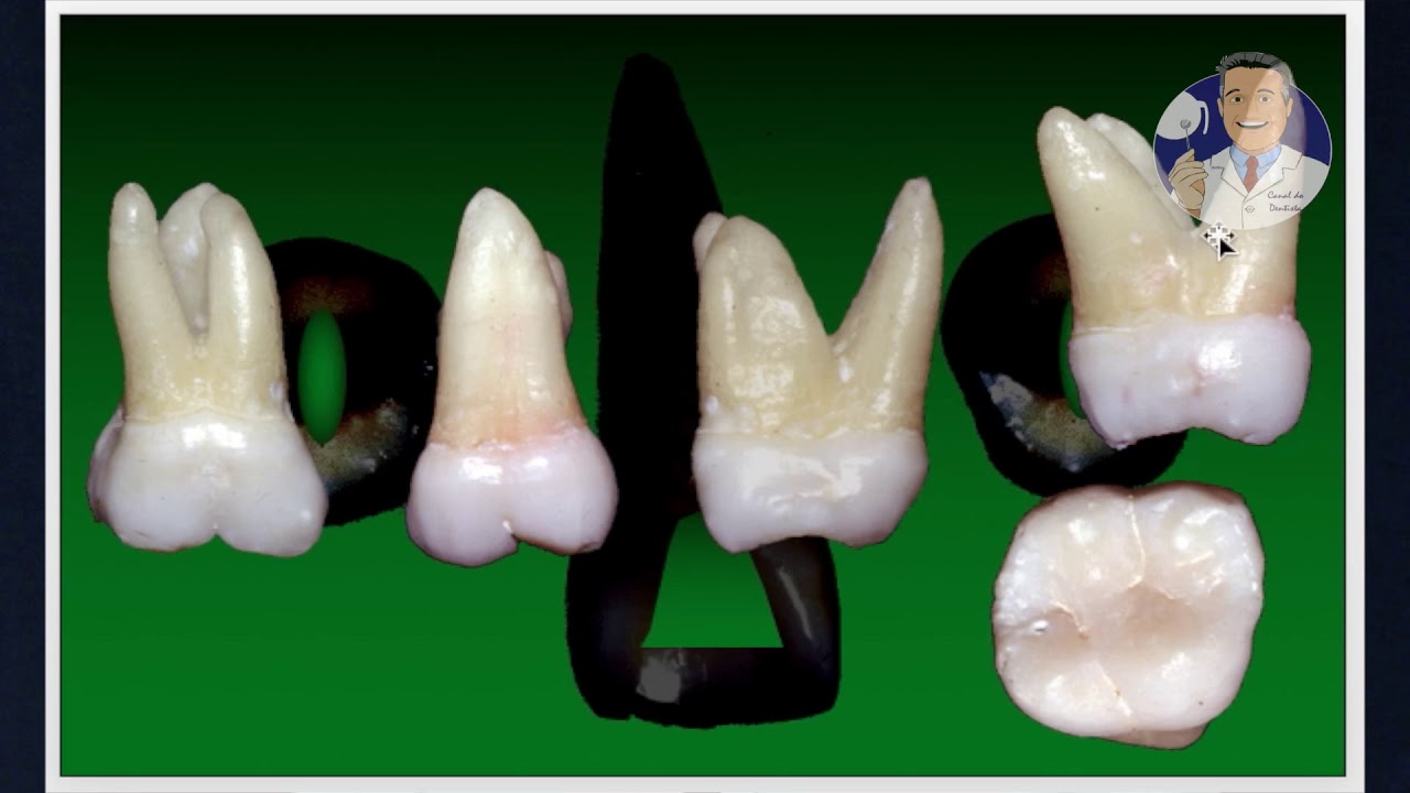 Módulo I - Aula 3: Cirurgia de Acesso - Molares Superiores