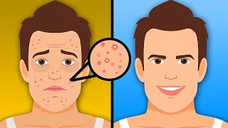 5 Natural ways to Get rid of Acne
