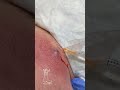 Spider Bite!    This is what a brown recluse  spider bite looks like early! - The Crawford Clinic Spider Bite!    This is what a brown recluse  spider bite looks like early!