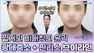 [유.케.리] 📍 CT로 보는 케이스 리뷰 l 두상 크기와 광대 l 비대칭 윤곽 라인 l 광대 축소 + 핀리스 브이라인 l