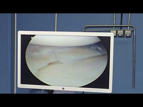 نجاح عملية خياطة الغضروف الهلالي بالمنظار مع دكتور ابراهيم شعراوي