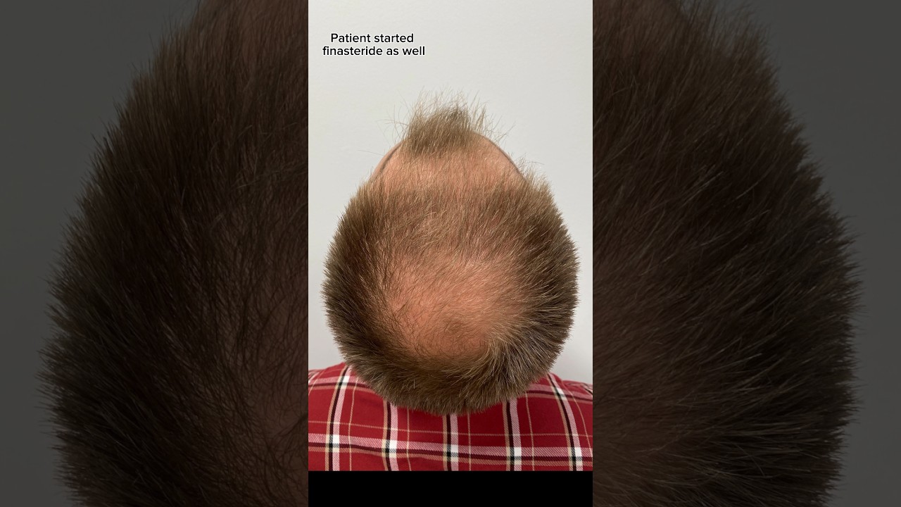 3600 Graft Hair Transplant Results! || Hair Transplant Austin, Texas
