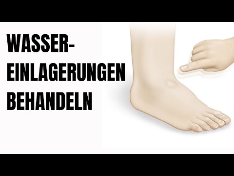 So behandelst du Wassereinlagerungen in den Beinen