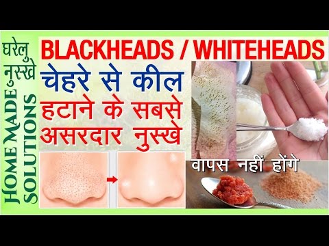 Remove BLACKHEADS / WHITEHEADS | चेहरे से किल ख़त्म करने के सबसे असरदार नुस्खे Video